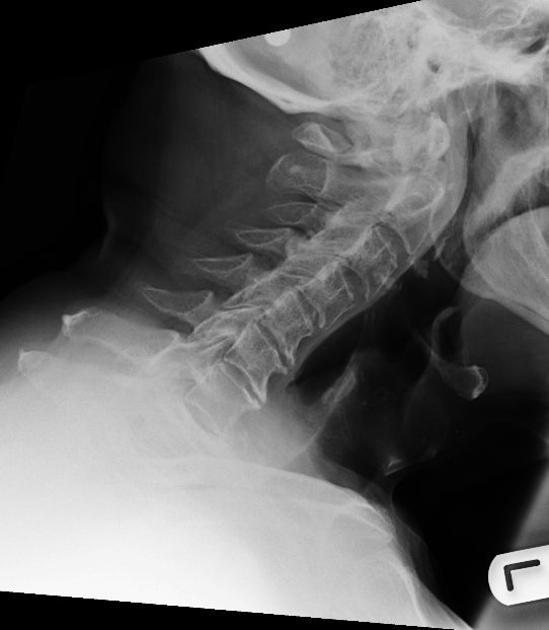 Odontoid Fracture Spine Orthobullets